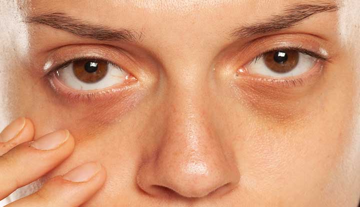 natural remedies for dark circles under eyes