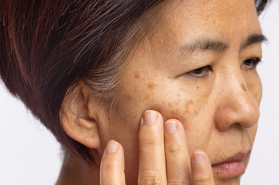 Natural remedies for hyperpigmentation on face