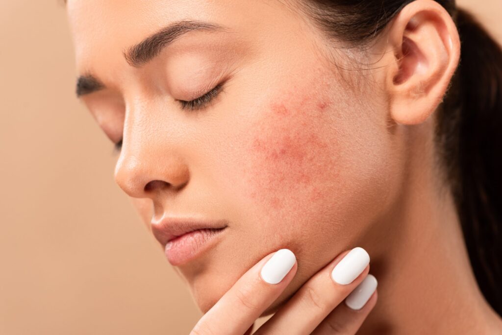 how to reduce acne scars with home remedies