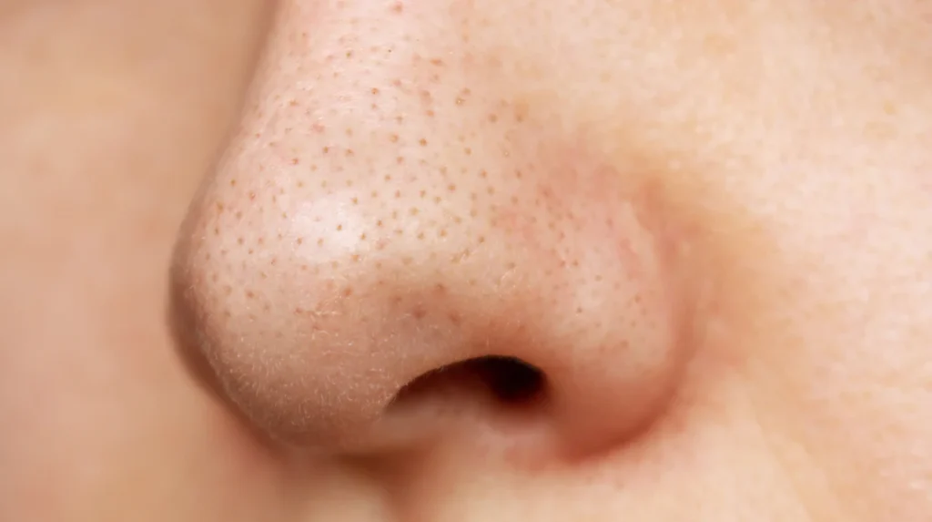 How to reduce large pores on nose