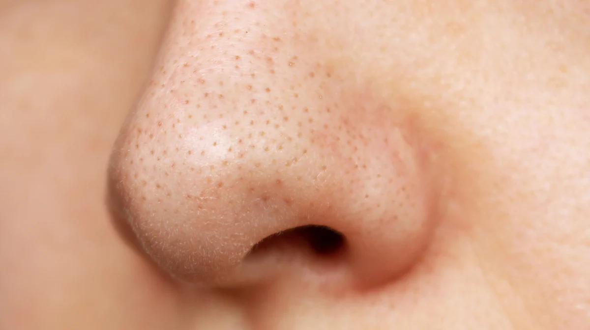 How to reduce large pores on nose