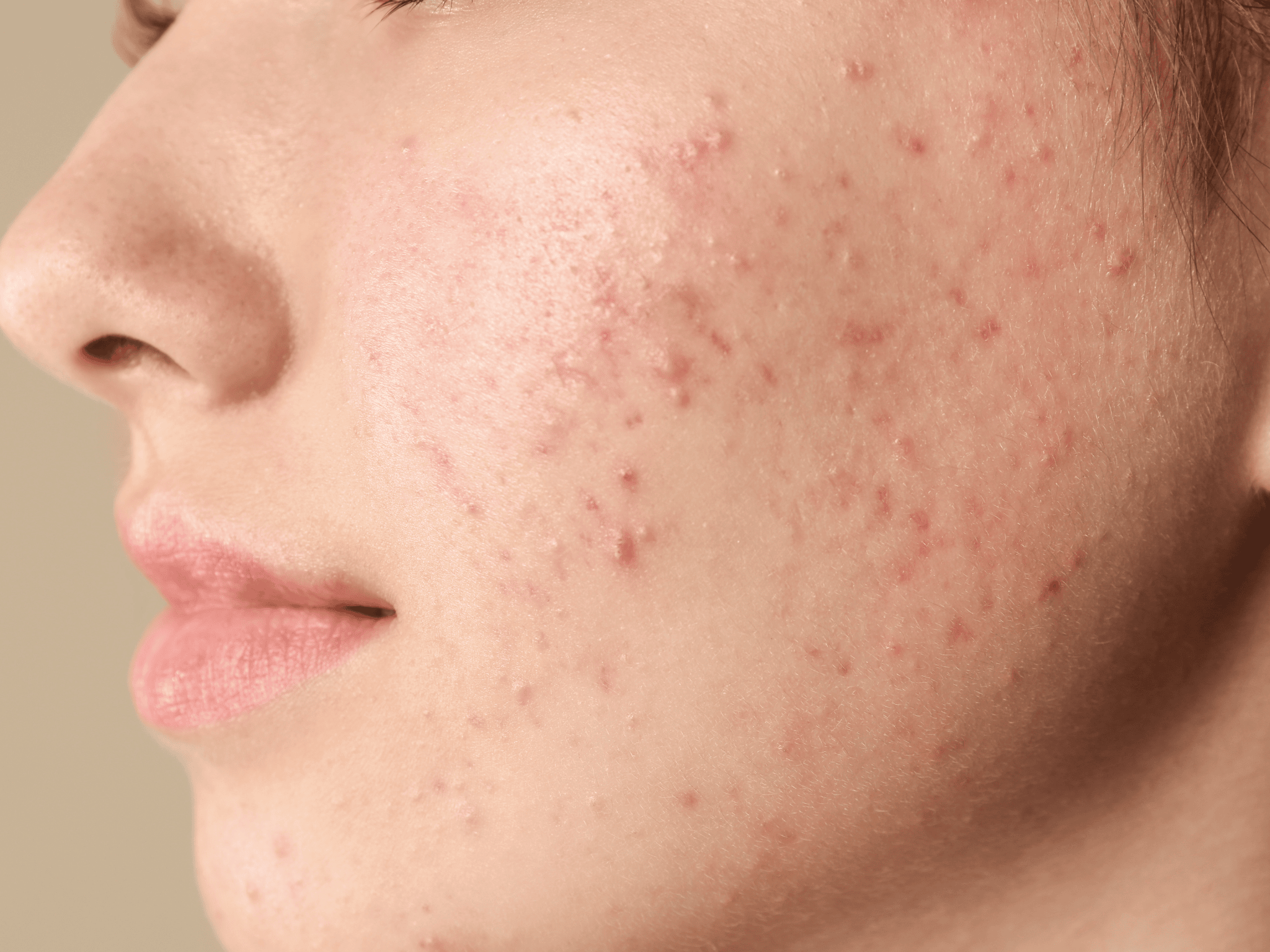 how to get rid of acne scars fast at home