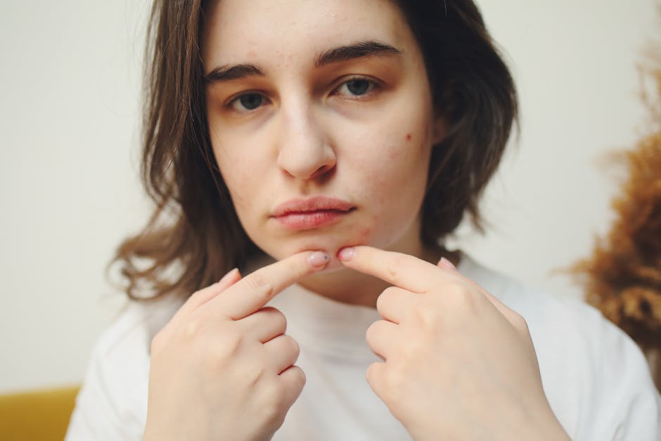 natural face treatment for pimples