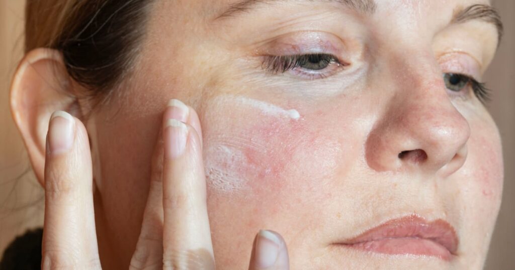 low‑impact skincare for acne rosacea