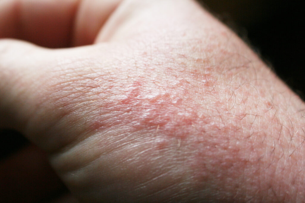 how to prevent heat rash in summer