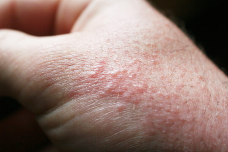 how to prevent heat rash in summer