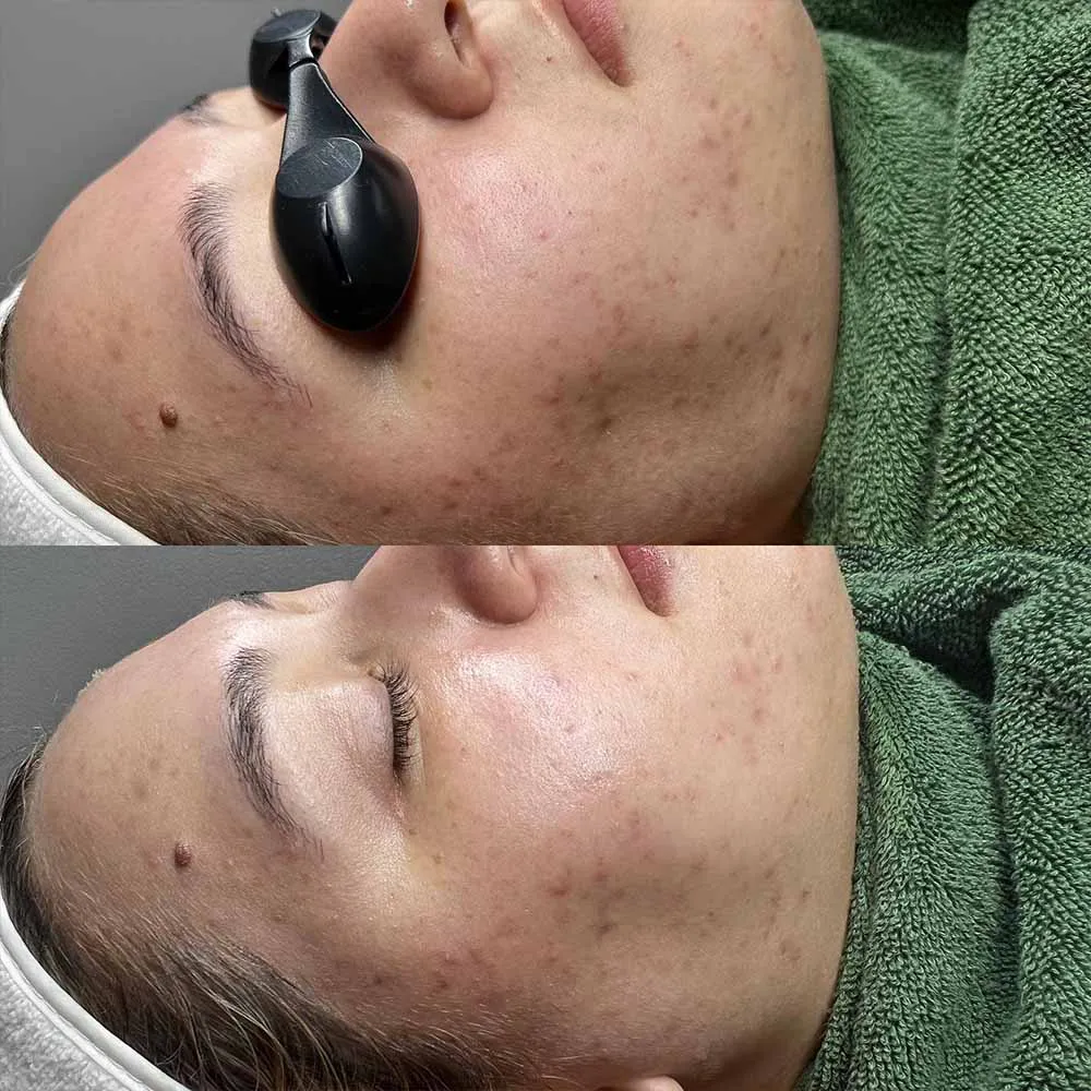 at‑home salicylic acid peel for blackheads