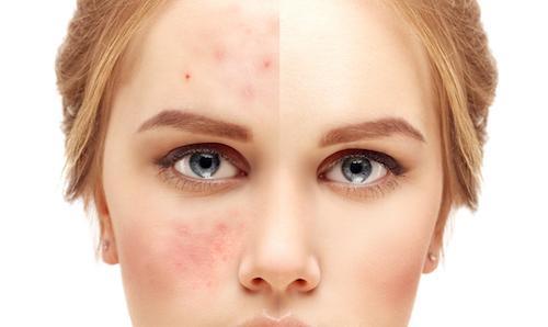 how diet affects skin acne and aging