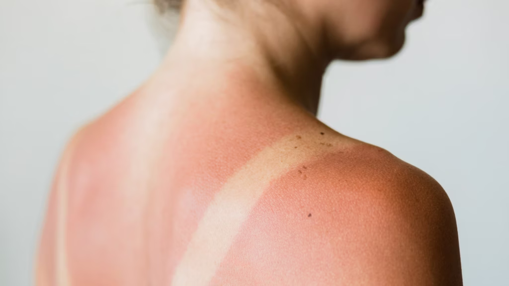 how to fix sunburned skin fast