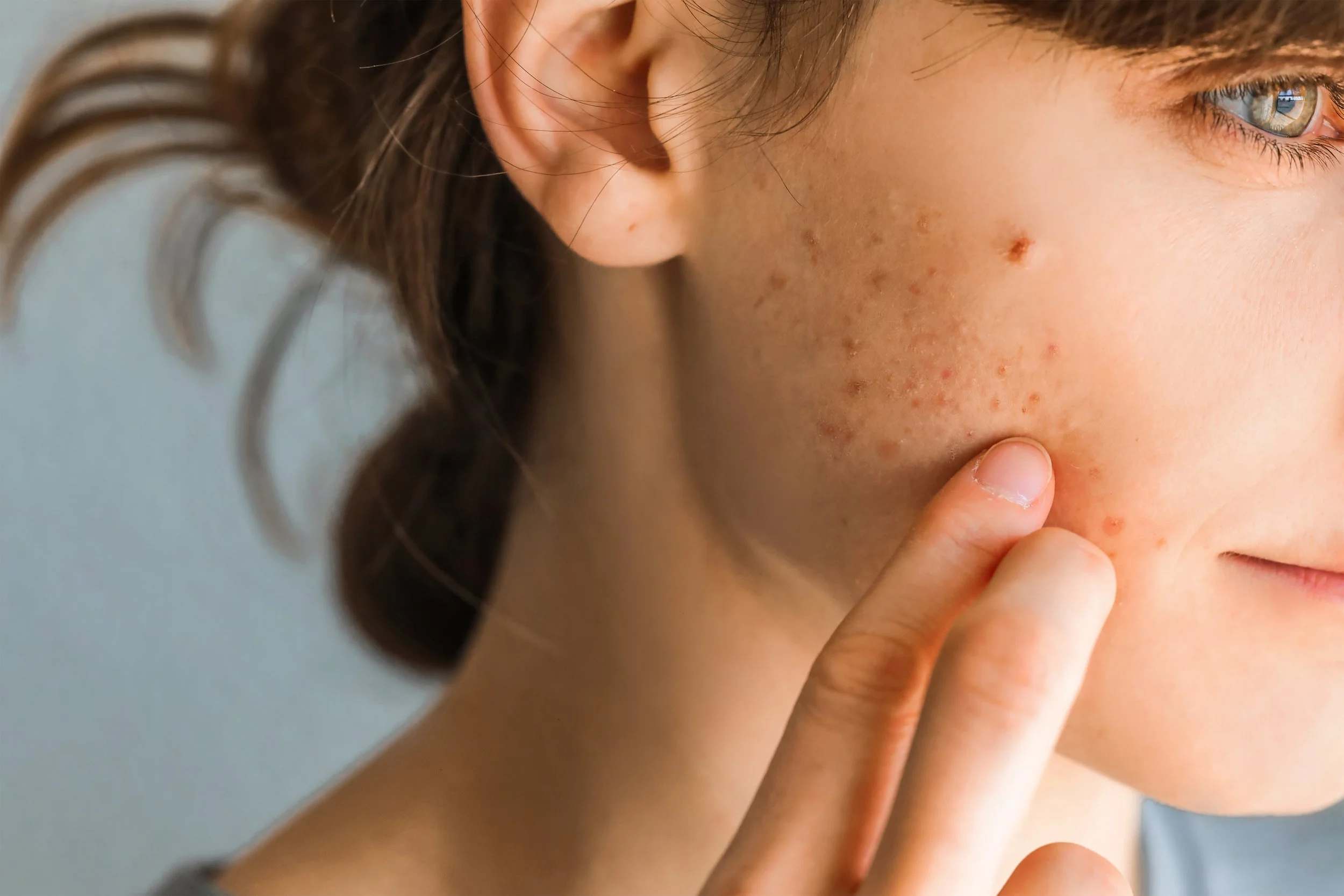 Skincare tips for teenagers with hormonal acne